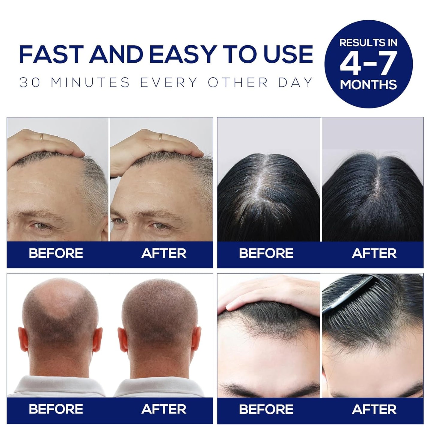 Laser Hair Growth Cap, Red Light Therapy Cap, Low Level Laser Therapy (LLLT) Equipment for Promoting Hair Growth in Women and Men(Black)