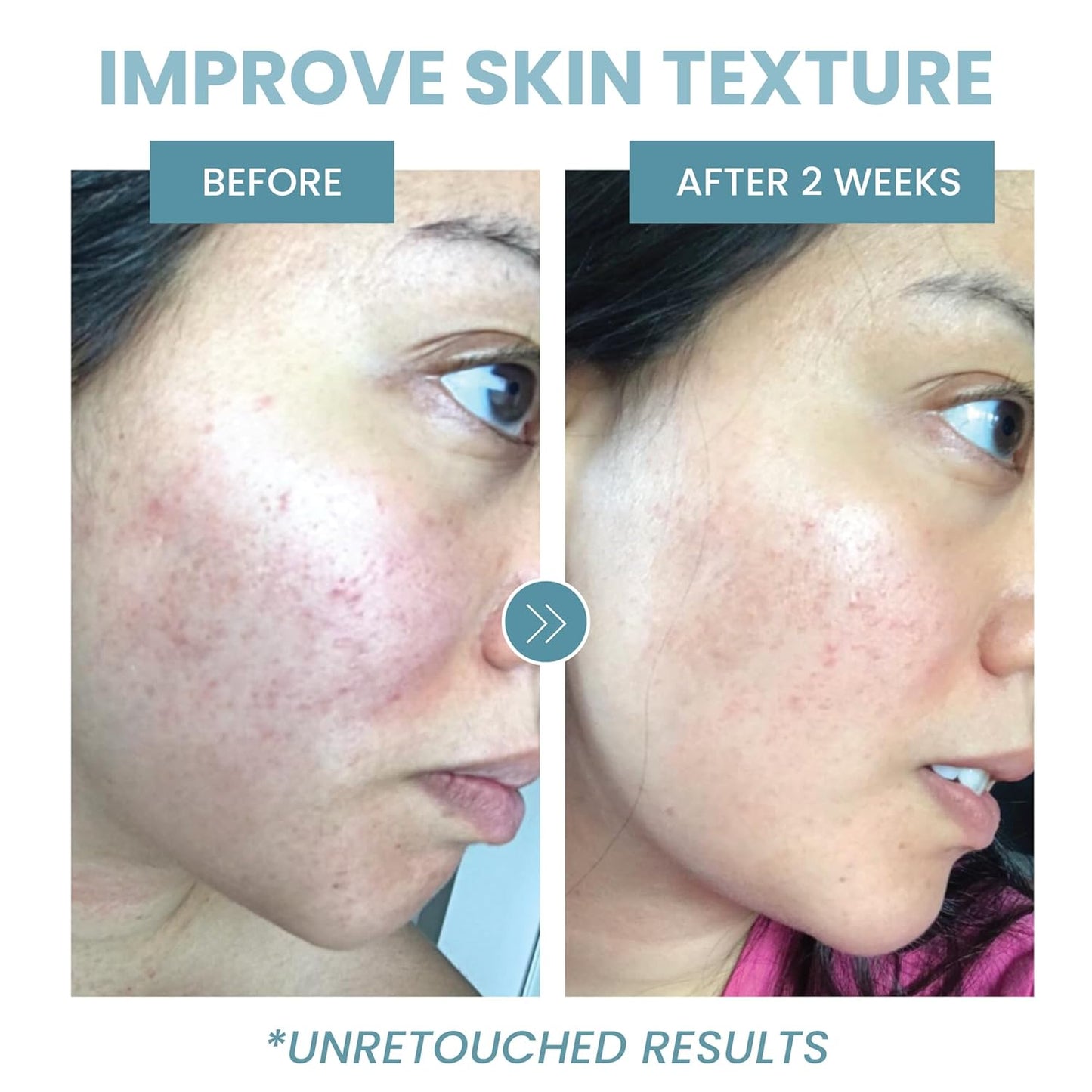 Collagen Peptide Serum for Face – Anti Aging Facial Treatment with Peptides & Hyaluronic Acid – Gentle for Sensitive Skin, Microneedling Pen, Derma Roller, Skin Firming & Hydrating (2 Oz) (2 Pack)