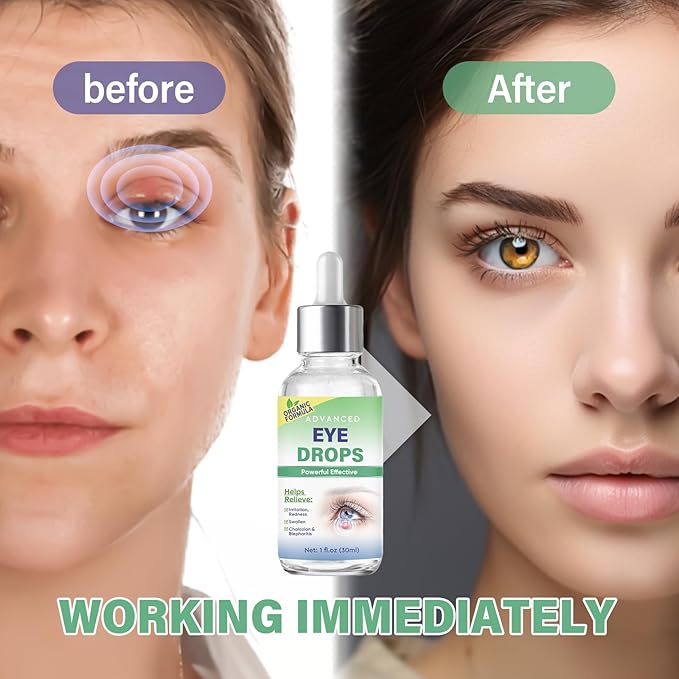 Stye Eye Treatment, Stye Eye Drops Serum for Styes Chalazion and Blepharitis, Chalazion Remover Fast Relief, Restore Healthier Eye Skin, 30ml