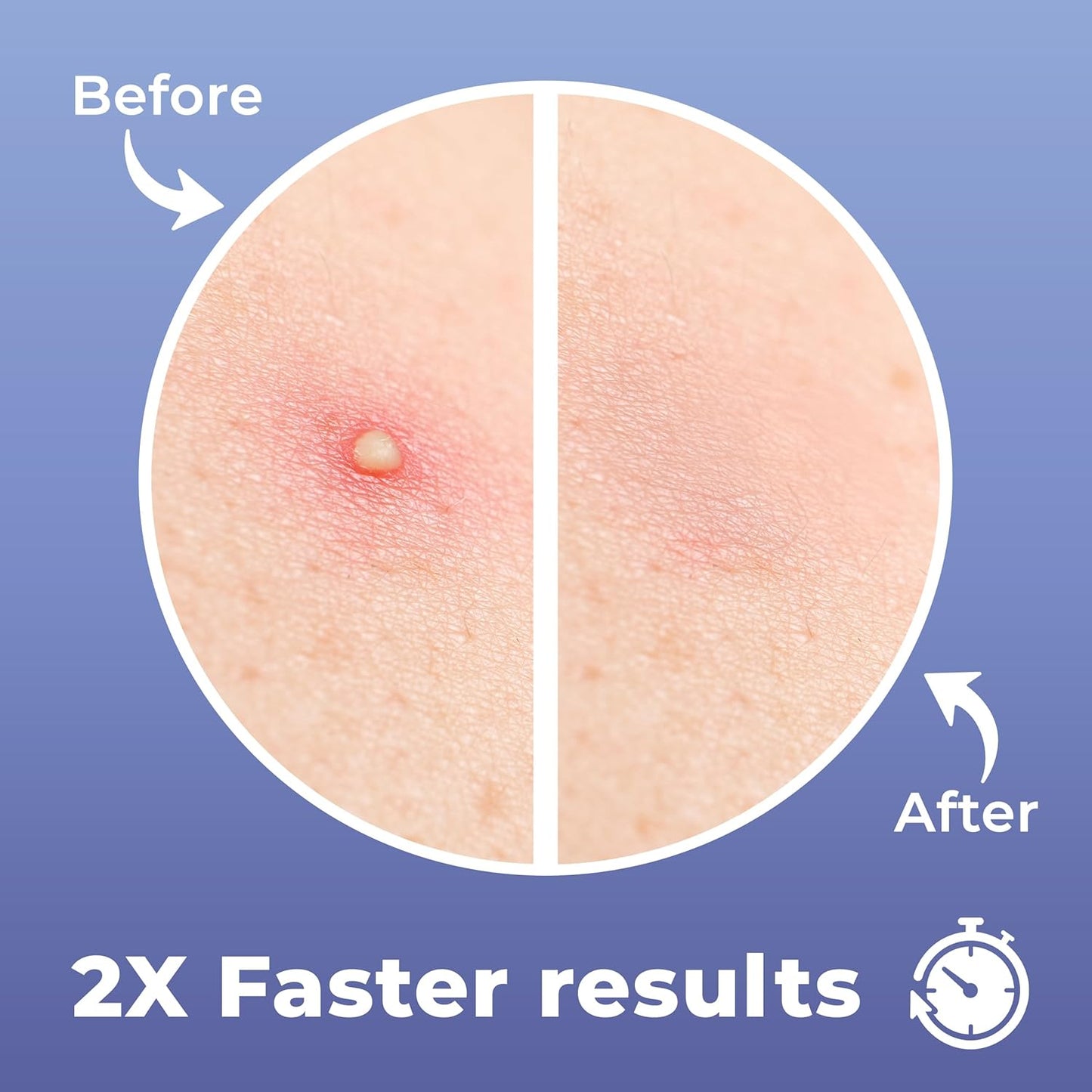 Salicylic Pimple Patches (120 Pack), Salicylic Acid Acne Patches with Tea Tree Oil - Zit Patch and Pimple Stickers for Face for Skin Care - Salicylic Acid Acne Dots (Packaging May Vary)