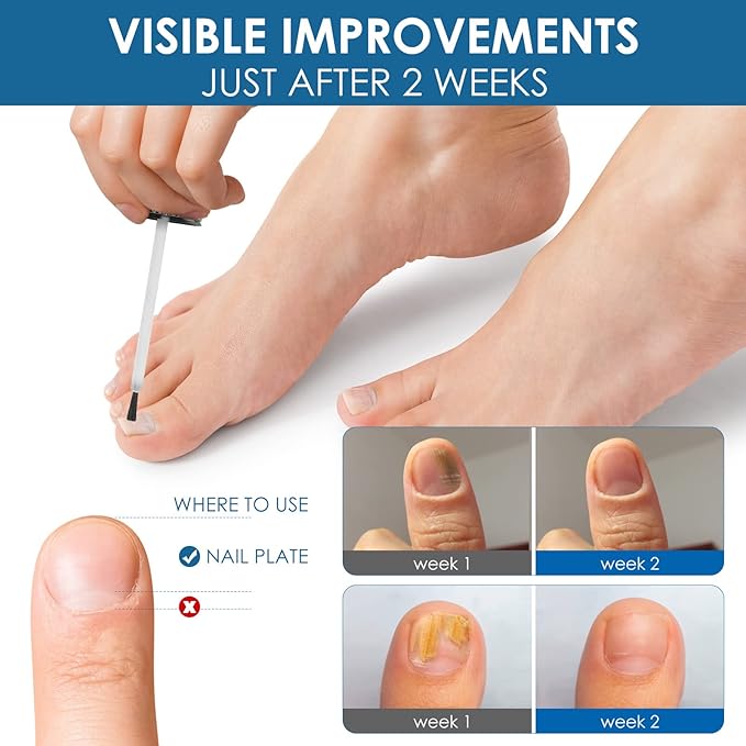 Toenail Repair Treatment, Extra Strength Nail Repair Liquid with Natural Tea Tree Oil Extract, Toenail Repair Solution for Thickened and Ingrow Nails