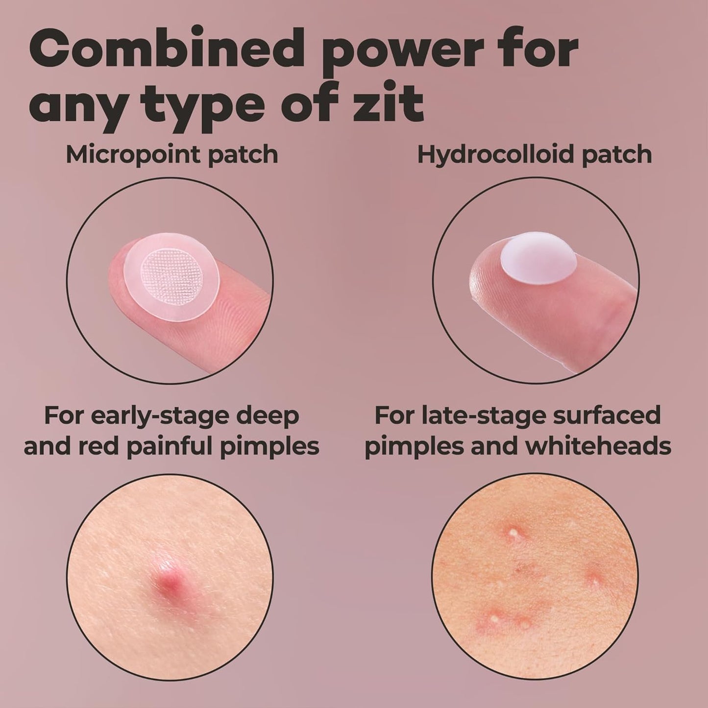 OMMA 72 Patches Pimple Patches for Face and 18 Micropoint Acne Patch Bundle