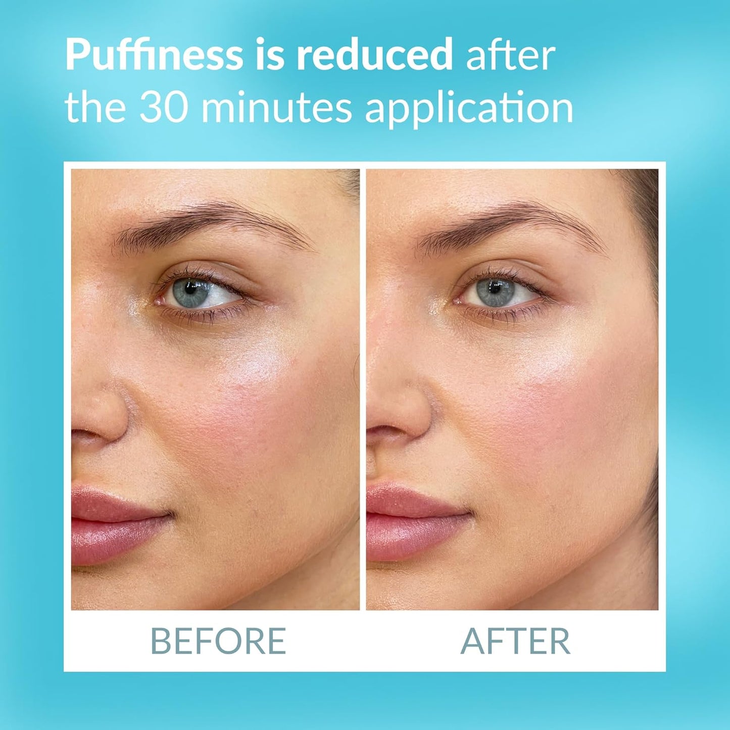 Talika Eye Therapy Patch - Instant Smoothing Eye Patches - Mask For Dark Circles & Tired Eyes - 6 Pairs Reusable & Travel Case