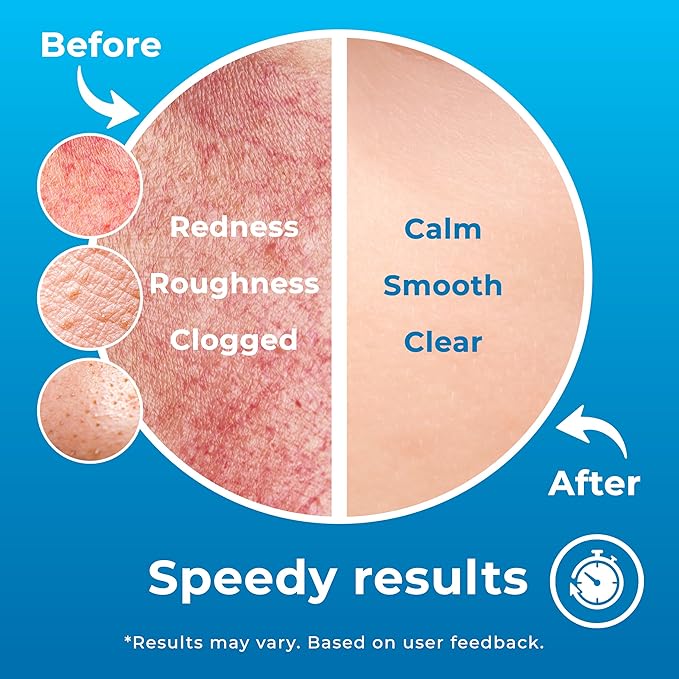 Hypochlorous Acid Spray (8oz, Reduces Acne), Targets Bacteria - HOCL Facial Cleanser Acne Spray for Face, Body, Eczema, Pimples, Breakouts & Overall Skin Recovery (Reduces Redness)